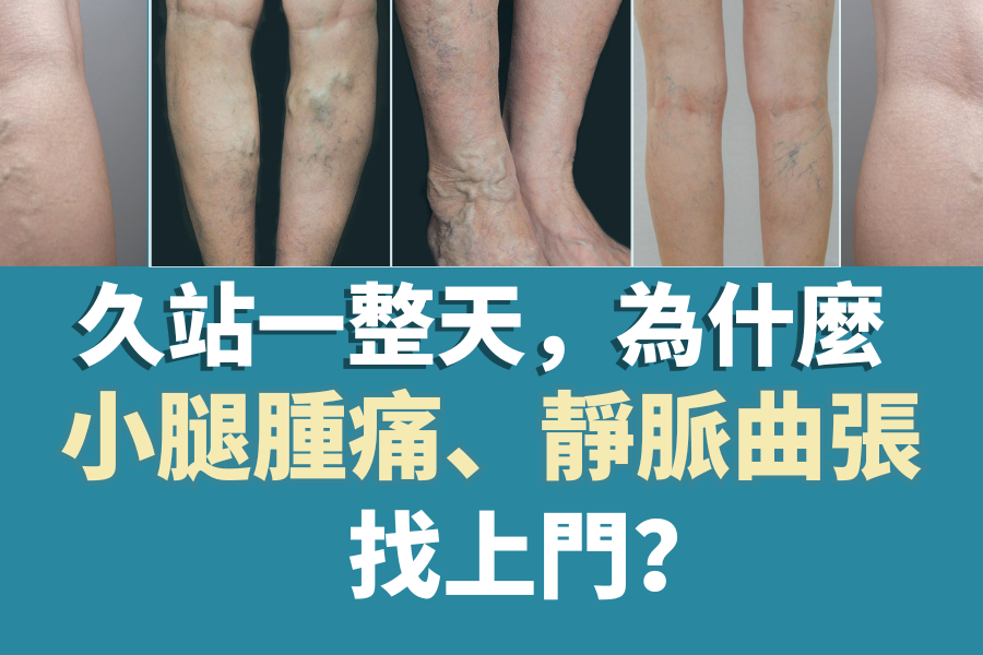 久站一整天，為什麼小腿腫痛、靜脈曲張找上門？